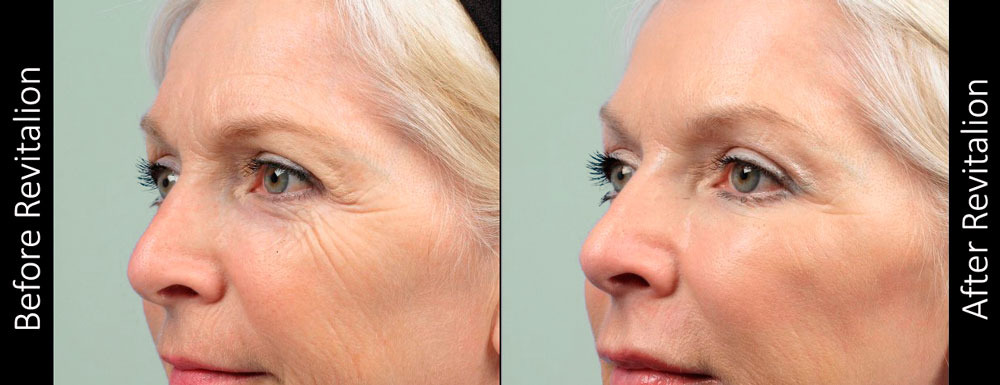 Before and After